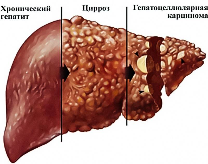 Неспецифический реактивный гепатит (K75.2)